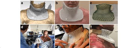 Design And Three Dimensional 3d Printing Of Patient Specific Splints