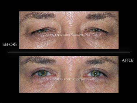 Plagued By Droopy Eyelids She Couldnt Keep Open This Woman Is Seen 3 Weeks After Conservative