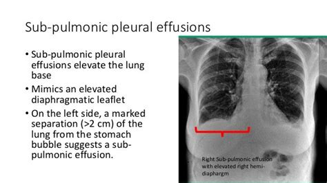 Pleural Effusionx Ray Findings