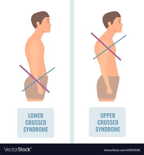 Lower And Upper Crossed Syndrome Body Diagram Vector Image