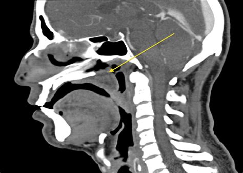 Ct Neck With Contrast In Sagittal Plane Heterogeneous Soft Tissue Is