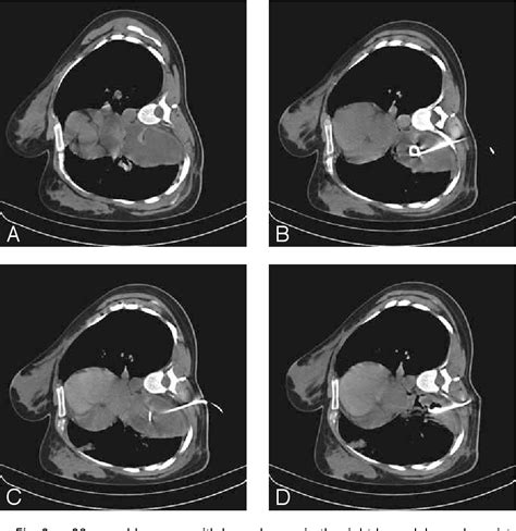 Pdf Ct Guided Percutaneous Drainage Of Lung Abscesses Review Of