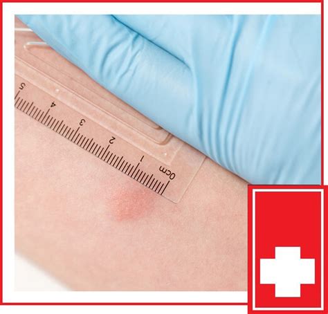 Tuberculosis Skin Test Or Tb Blood Test Near Me Urgent Care Clinic
