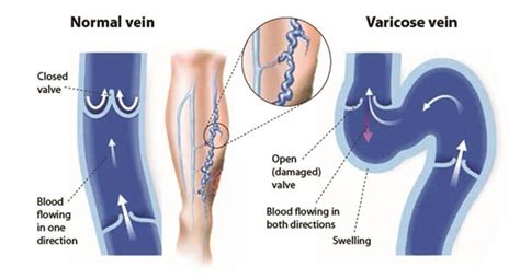Everything You Need To Know About Varicose Veins Thumbay Hospital Blog