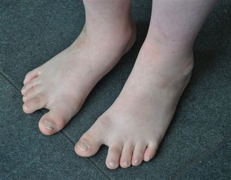 Filefeet Of A Boy With Down Syndrome Wikipedia The Free