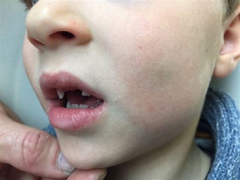 Extraoral Swelling Due To Bone Expansion The Tenderness To Palpation