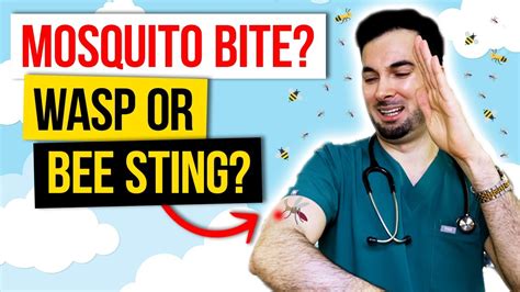 How To Treat A Mosquito Bites And Insect Home Remedies Youtube