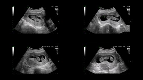 Twins Ultrasound 6 Weeks