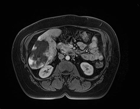 Giant Liver Hemangioma With Central Scar Body Mr Case Studies