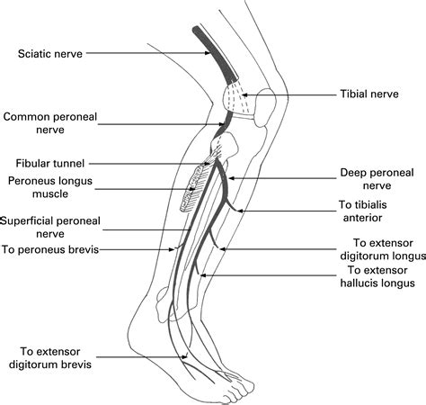 Foot Drop Where Why And What To Do Practical Neurology