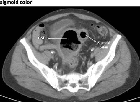 Figure From Giant Sigmoid Diverticulum A Case Report Semantic Scholar