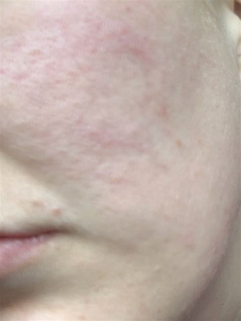 Acne Unidentifiable Bumps On Face Help Please Skincareaddiction
