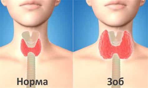 Зоб диета лечение Зоб Хашимото (Хасимото): причины и симптомы, лечение болезни Зоб Хашимото (Хасимото): причины и симптомы, лечение болезни Зоб диета лечение