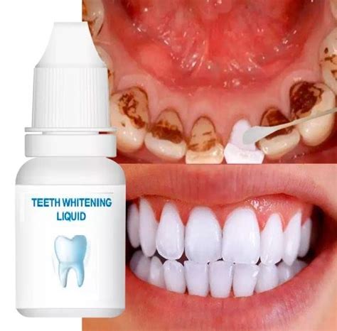 Teeth Whitening Essence Teeth Brightener Gel Kit Teeth Whitening