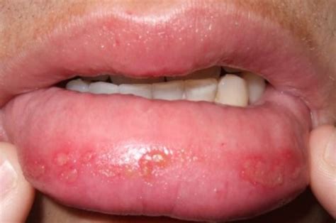 Sunburned Lips Symptoms Blistered And Swollen Relief Skincarederm
