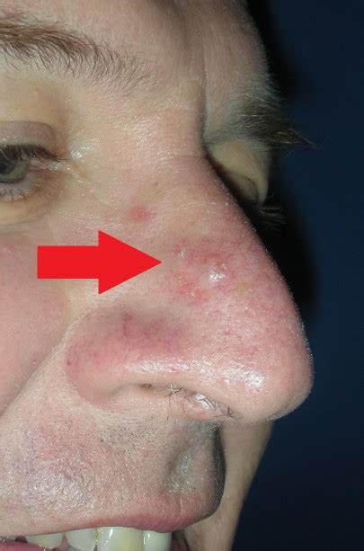 Skin Cancer Signs Of Skin Cancer On Nose
