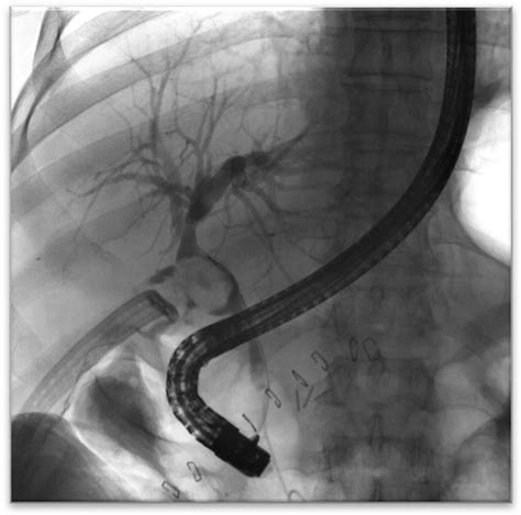 Ercp Indicating Multiple Filling Defects In The Hepatic Ducts And