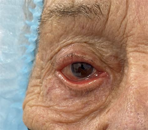 Ectropion Repair Outwards Turned Eyelid Benoe