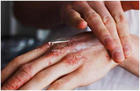 Scabies Vs Eczema Differences In Symptoms Causes And Treatment