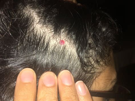Skin Concerns Red Dot On Scalp Red Dots Skin Behind Ear Tattoo