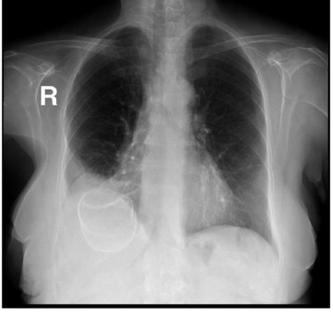 Chest X Ray Showing A Calcified Lesion In The Right Upper Quadrant Of