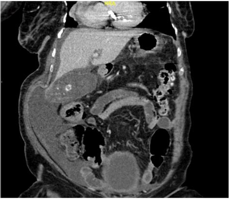 Coronal Section Of Abdominal Ct With Iv Contrast Showed Distended
