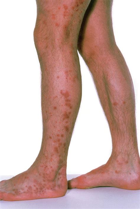 Bed Bug Bites On Persons Legs Photograph By Science Photo Library