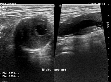 Aneurysma Arteria Poplitea Verwijding Knieslagader Simpto Nl