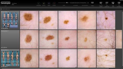 Dermagraphix® And Technological Advancements Related To Checking Moles