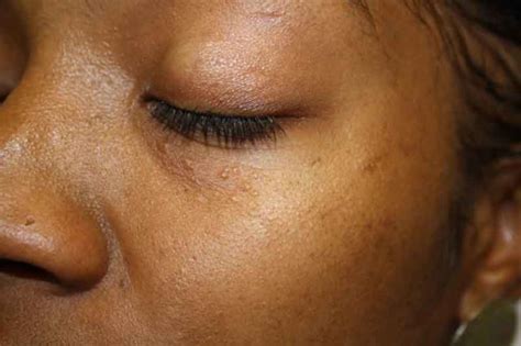 Syringoma Benign Neoplasm Of Skin Dermatology Advisor