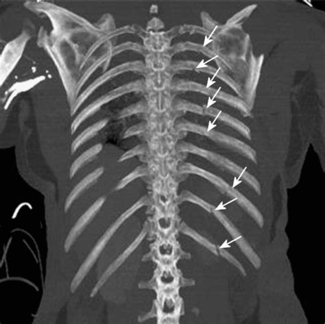 Rib Fracture Wikem