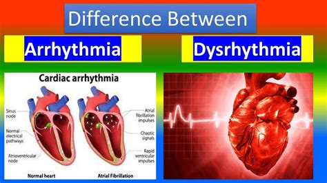 Arrhythmia Vs Dysrhythmia Youtube