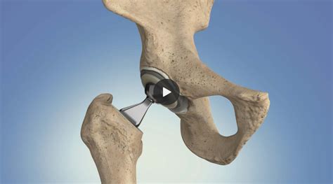 Hip Replacement What You Need To Know The Operating Room Global Torg