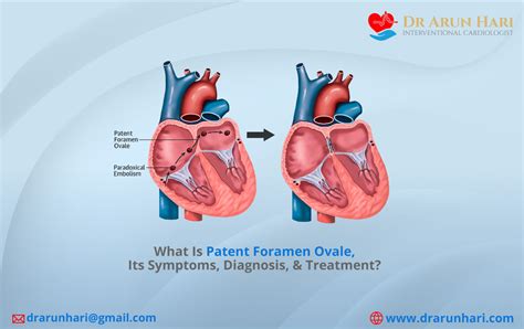 What Is Patent Foramen Ovale Its Symptoms Diagnosis And Treatment