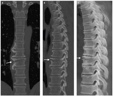 Imaging Thoracolumbar Spine Trauma Radiology Key