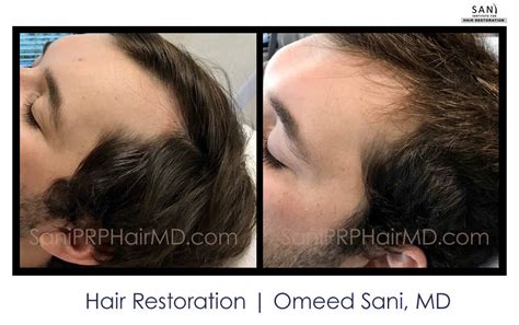 Non Surgical Hair Restoration Gallery Photos Of Actual Patients Sani