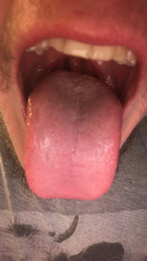 Red Bumps In Back Of Tongue What Could This Be Medical
