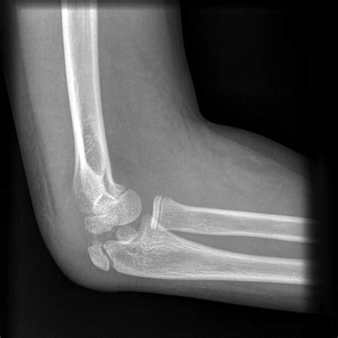 Elbow Fracture X Ray Elbow