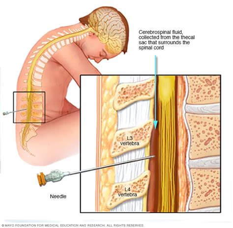 Lumbar Puncture Spinal Tap Mayo Clinic