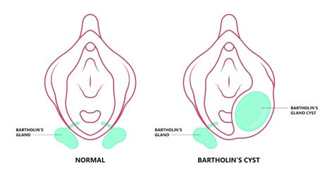 bartholin s cyst causes symptoms and removal andrew krinsky md facog