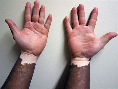 Vitiligo Taches Blanches Dépigmentation De La Peau Causes Et