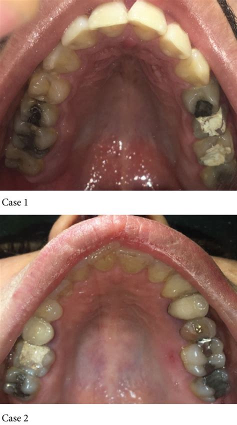 Preoperative View Of Tooth 16 And 26 With Temporary Restoration After