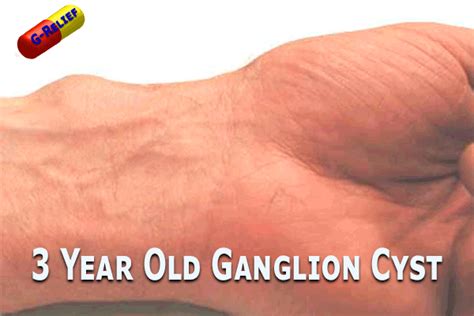 Testimonial G Relief Cure For Ganglion Cysts Suegery Alternative Fda