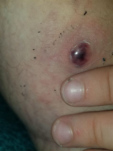 There are ways to deal with. Possible cyst? Ingrown hair? Bug bite?? You tell … - medical