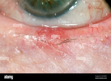 Close Up Of A Chronically Inflamed Chalazion Meibomian Cyst On The
