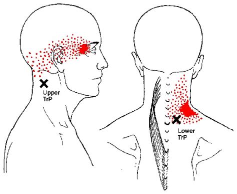 Splenius Capitis And Cervicis Trigger Points And Referred Pain Patterns