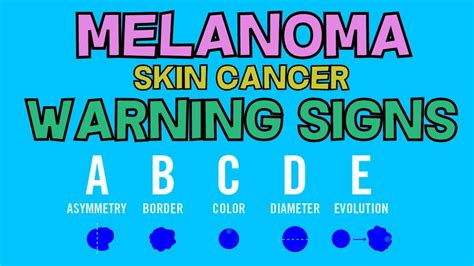 Melanoma Skin Cancer Warning Signs Abcde Diagnostic Assessment