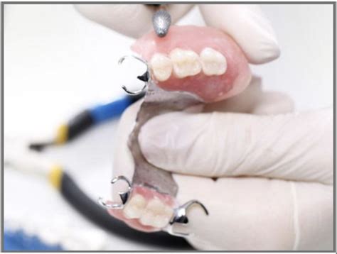 Metal Partials Partial Denture Clasps Kissimmee Dental — Dental