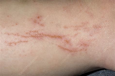 Atopic Eczema With Scratch Marks Stock Image C002 9569 Science