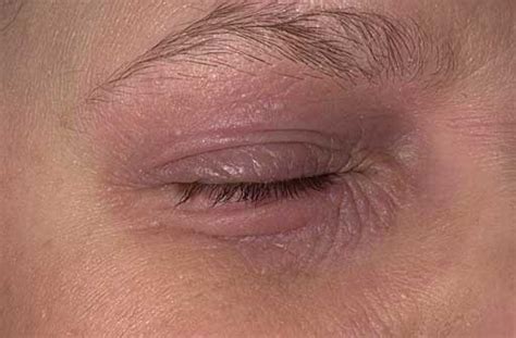 How To Treat Eczema On My Eyelids Quora